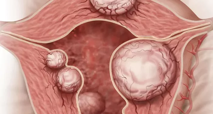 4 Possible Effects of Extrauterine Fibroids on Infertility