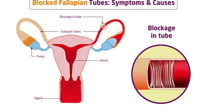 what are symptoms of fallopian tubes blocked