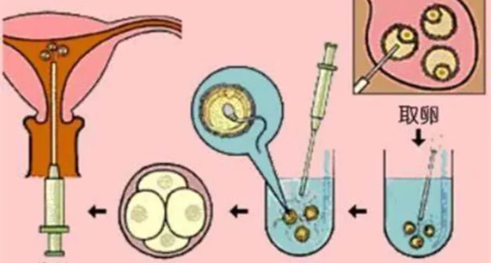 IVF Flowchart