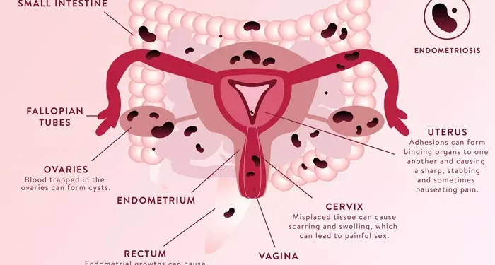 Endometriosis